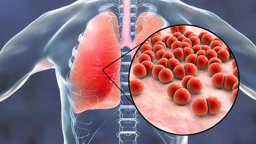 Las infecciones respiratorias agudas representan una de las primeras causas de muertes en menores de cinco años